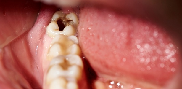 Dente Furado , o que fazer? - Newdental Produtos Odontológicos